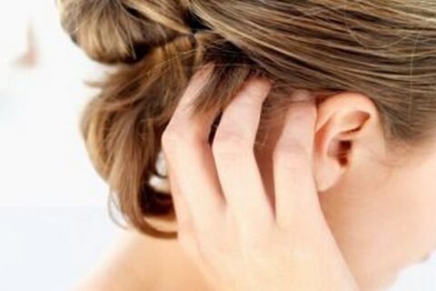 Scalp psoriasis: Effective home remedies for relief
